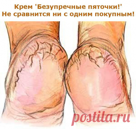 Крем 'Безупречные пяточки!'...не сравнится ни с одним покупным!

Поделюсь с вами рецептом крема для пяток, который не сравнится ни с одним покупным средством. И самое главное - сделать его легко и быстро. Нужно только купить в аптеке тюбик мази календулы (20г) и ампулку жидкого витамина А (10 мл), так будет легче дозировать, поскольку соотношение должно быть 1:2. В небольшой емкости хорошенько перемешайте витамин А и мазь. Вот собственно и все. Затем переложите готовый кре...