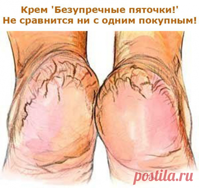 Крем 'Безупречные пяточки!'...не сравнится ни с одним покупным!

Поделюсь с вами рецептом крема для пяток, который не сравнится ни с одним покупным средством. И самое главное - сделать его легко и быстро. Нужно только купить в аптеке тюбик мази календулы (20г) и ампулку жидкого витамина А (10 мл), так будет легче дозировать, поскольку соотношение должно быть 1:2. В небольшой емкости хорошенько перемешайте витамин А и мазь. Вот собственно и все. Затем переложите готовый кре...