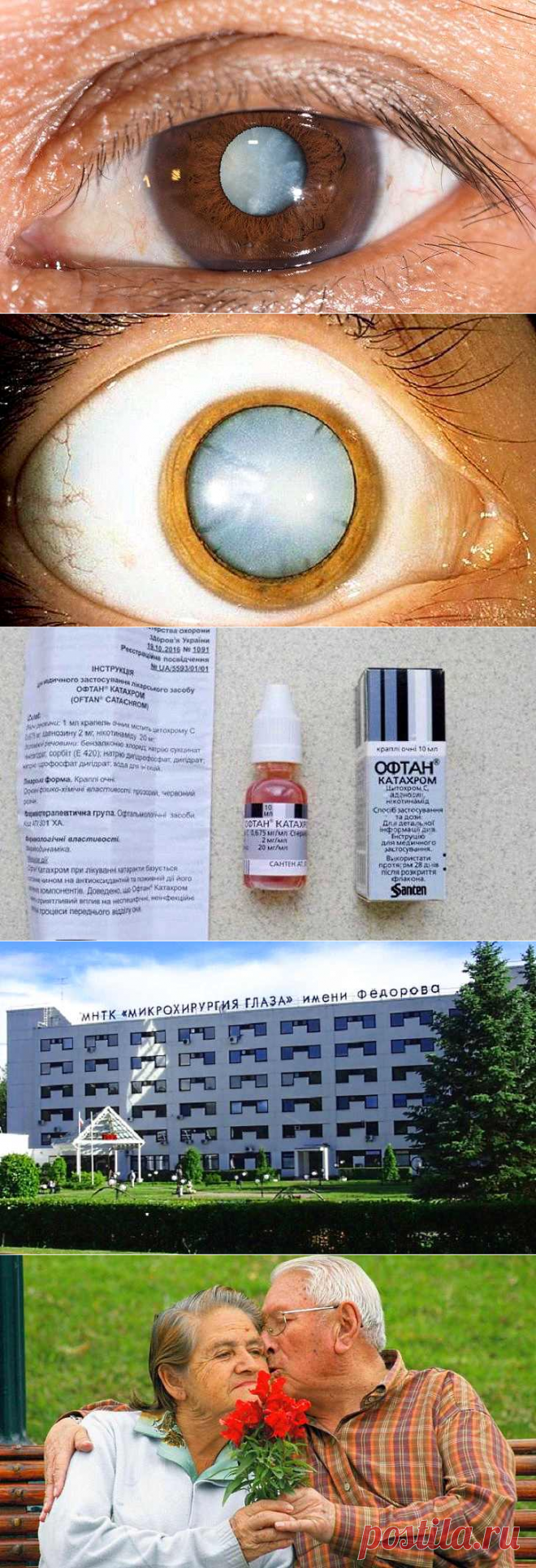 Катаракта: причины, симптомы, лечение и профилактика