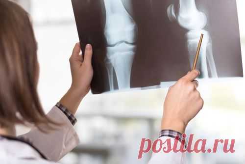 Истощение сустава. Как справиться с артрозом | Здоровая жизнь | Здоровье | Аргументы и Факты