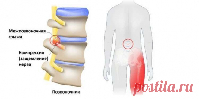 Как распознать защемление седалищного нерва и что с этим делать
Помочь может простейшая растяжка. Что такое защемление седалищного нерва Седалищный нерв — самый длинный What is Sciatica нерв в человеческом теле. Он начинается в нижней части спины, в районе поясницы, и, расщепляясь на две части, тянется через ягодицы, бёдра, икры к ступням. Именно этот нерв обеспечивает подвижность ног, связывая расположенные в них мускулы с ЦНС. Но […]
Читай дальше на сайте. Жми подробнее ➡