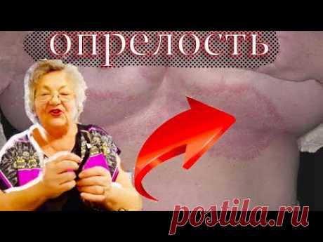 Да хватит уже мучаться! Опрелости под грудью не будут больше беспокоить летом