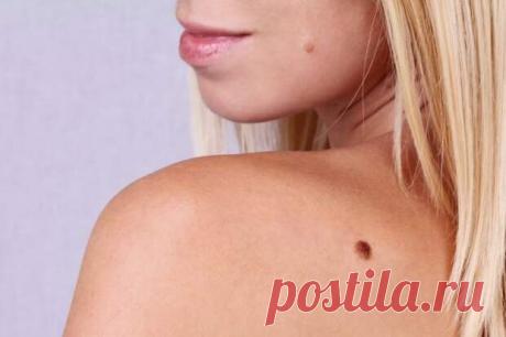 Чем опасны родинки и папилломы
«У меня довольно много родинок и есть несколько папиллом. Хотела узнать, чем могут быть опасны родинки и как часто их нужно наблюдать? Обязательно ли удалять папилломы? Какие методики для удаления родинок и папиллом сегодня существуют? Также хотелось бы узнать про разные варианты процедур и понять их особенности». Читательница, 36 Ответ специалиста: Главная опасность родинок (невусов) […]
Читай пост далее на сайте. Жми ⏫ссылку выше