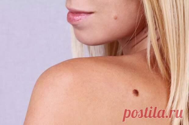 Чем опасны родинки и папилломы
«У меня довольно много родинок и есть несколько папиллом. Хотела узнать, чем могут быть опасны родинки и как часто их нужно наблюдать? Обязательно ли удалять папилломы? Какие методики для удаления родинок и папиллом сегодня существуют? Также хотелось бы узнать про разные варианты процедур и понять их особенности». Читательница, 36 Ответ специалиста: Главная опасность родинок (невусов) […]
Читай пост далее на сайте. Жми ⏫ссылку выше