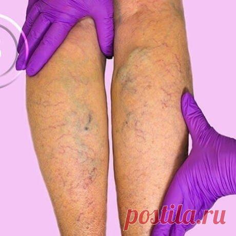 Эта мазь вам обязательно поможет!

Потребуется.
Свиное топленое сало, сок алоэ, мед, мазь Вишневского, мазь ихтиоловая, хозяйственное жидкое мыло, сок репчатого лука. * Готовим.
По 1 ст. ложке каждого из компонентов поместить в маленькую кастрюлю и, помешивая, нагреть до кипения, но не кипятить! Остудить. * Применяем.
Мазь нанести на ноги и, обернув чистой марлей или х/б тканью, забинтовать не туго. С повязкой ходить весь день и оставить на ночь.

Утром положить новую повя...