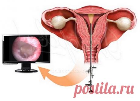Гистероскопия матки диагностическая, процедура, осложнения
Гистероскопия матки диагностическая, показания и противопоказания, возможные осложнения, подготовка к процедуре, правила после гистероскопии с выскабливанием