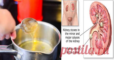 Самые лучшие растительные лекарственные средства для устранения камней в почках — Домашние заботы