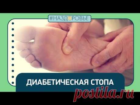 #НАЗДОРОВЬЕ: диабетическая стопа