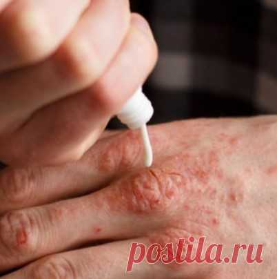 НАТУРАЛЬНЫЕ КРЕМЫ ДЛЯ ЛЕЧЕНИЯ ПСОРИАЗА: ПОПРОБУЙТЕ ЭТИ РЕЦЕПТЫ!