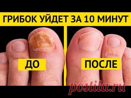 ГРИБОК НОГТЕЙ быстро исчезнет, если 10 минут в день применять эти способы!