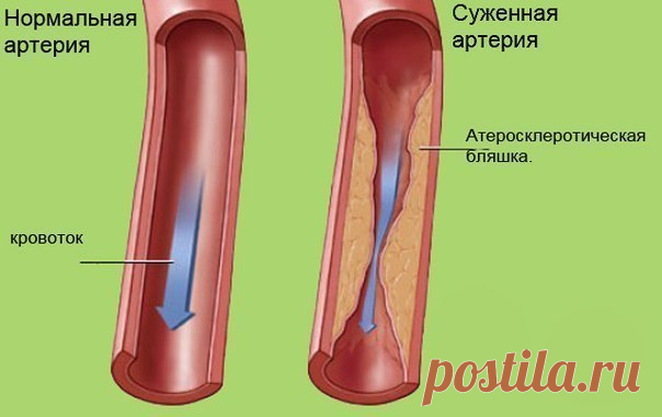 Очищение сосудов. Лучшие методики.