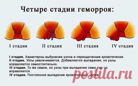 Она больше не боится ГЕМОРРОЯ! Смотри, 10 самых эффективных средств от свай.