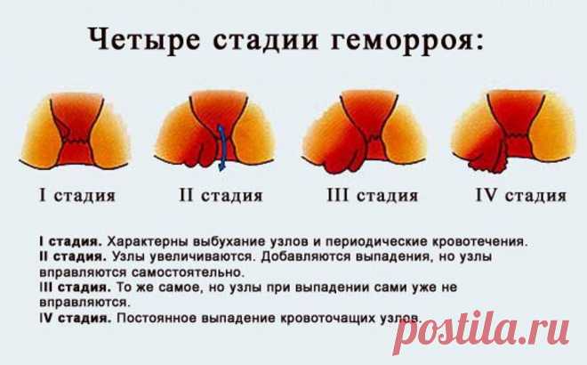 Она больше не боится ГЕМОРРОЯ! Смотри, 10 самых эффективных средств от свай.