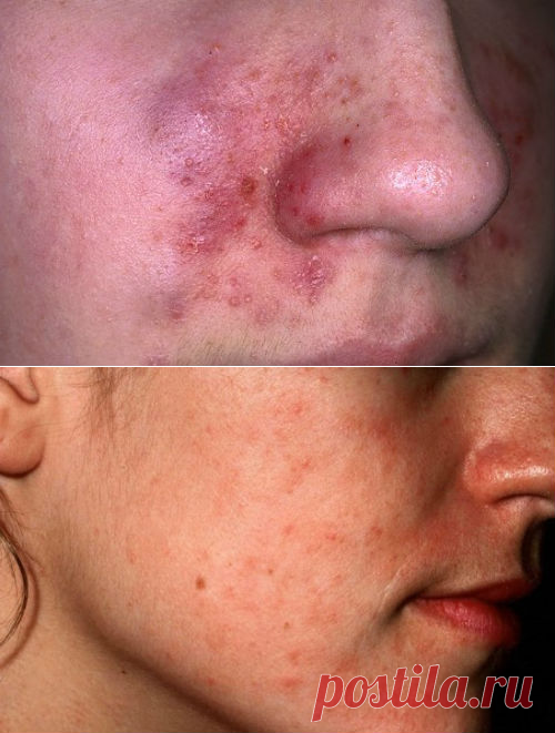Псориаз на лице, лечение, причины возникновения, симптомы, фото