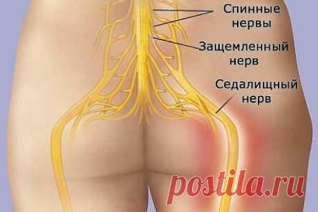 КАК РАЗБЛОКИРОВАТЬ СЕДАЛИЩНЫЙ НЕРВ