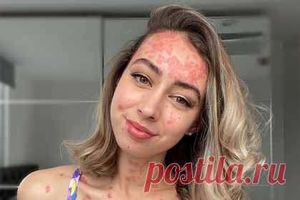 Девушка с псориазом показала тайное тату и раскрыла его значение. На размещенном снимке транслирующая идеи бодипозитива девушка предстала в нижнем белье, продемонстрировав тату в виде стрелы и тело, пораженное псориазом. Блогерша объяснила, что нанесенный в области ребер рисунок важен для нее, поскольку значит борьбу с болезнью и ожидаемую победу над ней.
