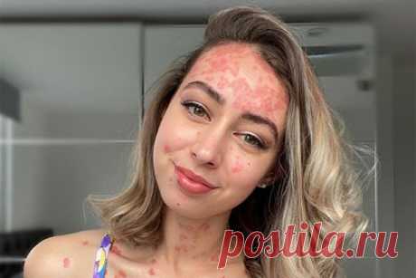 Девушка с псориазом показала тайное тату и раскрыла его значение. На размещенном снимке транслирующая идеи бодипозитива девушка предстала в нижнем белье, продемонстрировав тату в виде стрелы и тело, пораженное псориазом. Блогерша объяснила, что нанесенный в области ребер рисунок важен для нее, поскольку значит борьбу с болезнью и ожидаемую победу над ней.