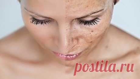 Убираем пигментные пятна