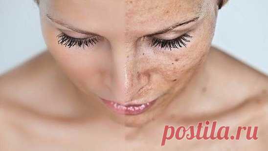 Убираем пигментные пятна