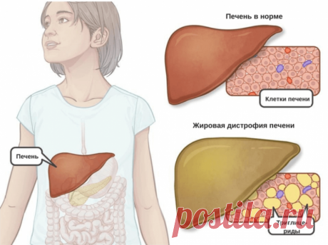 Как поддержать печень при жировой болезни Лечение НАЖБП предполагает коррекцию образа жизни, устранение метаболического синдрома, терапию осложнений цирроза и, если необходимо, медикаментозное вмешательство. Определенные вещества демонстрирую...