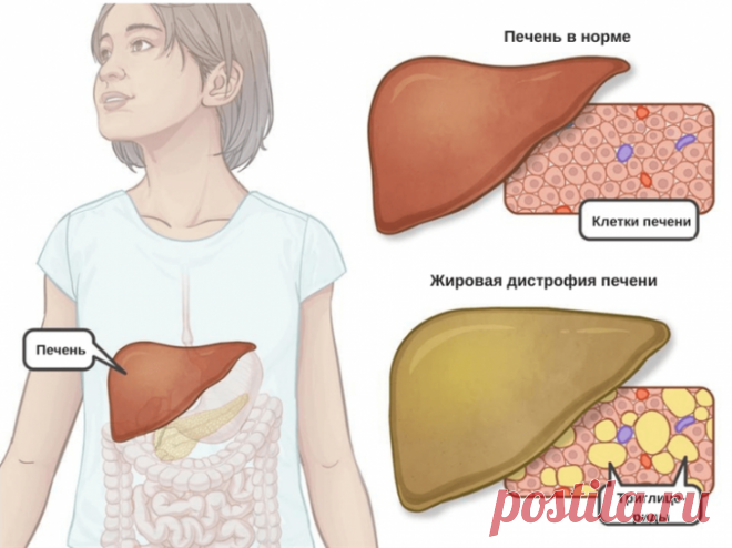 Как поддержать печень при жировой болезни Лечение НАЖБП предполагает коррекцию образа жизни, устранение метаболического синдрома, терапию осложнений цирроза и, если необходимо, медикаментозное вмешательство. Определенные вещества демонстрирую...