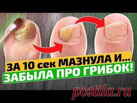 Как я навсегда уничтожила грибок ногтей! Грибок ногтей на ногах лечение в домашних условиях