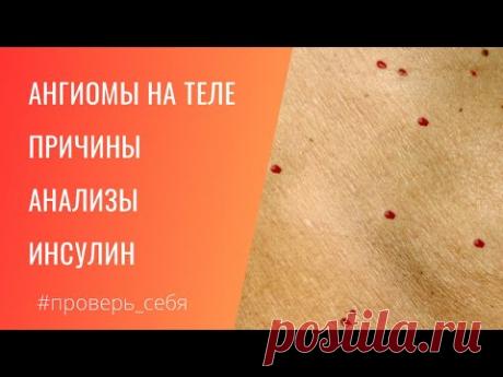 Красные точки на теле. Инсулинорезистентность