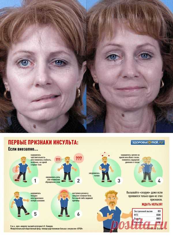 Спасти от инсульта могут всего три простых правила! (Это НАДО знать!)