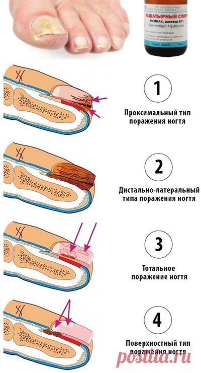 Нашатырный спирт от грибка ногтей на ногах и руках: отзывы, эффективность, популярные рецепты