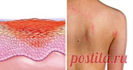 Ваша кожа расскажет вам про серьезные внутренние болезни