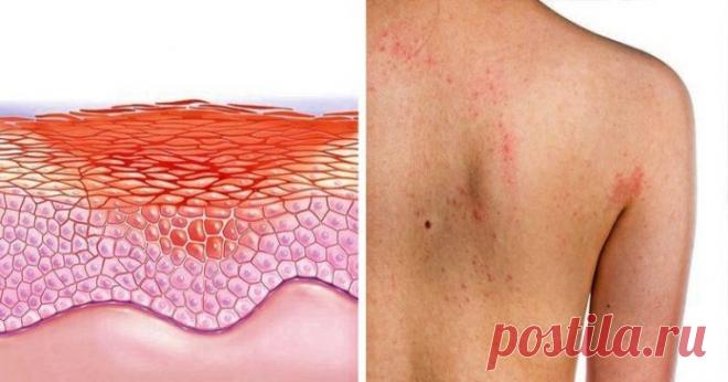 Ваша кожа расскажет вам про серьезные внутренние болезни