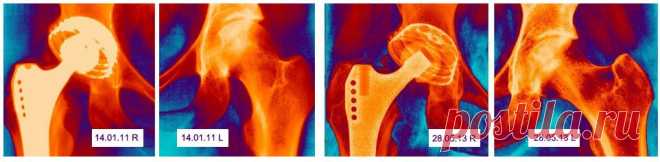Специализированный центр по лечению асептического некроза