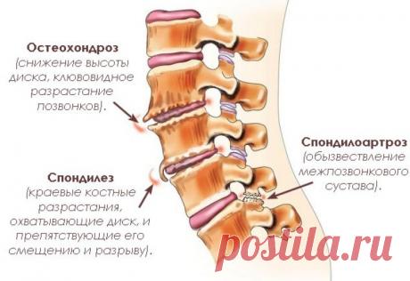 Спондилоартроз позвоночника. Симптомы, диагностика, лечение