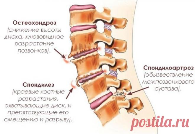 Спондилоартроз позвоночника. Симптомы, диагностика, лечение