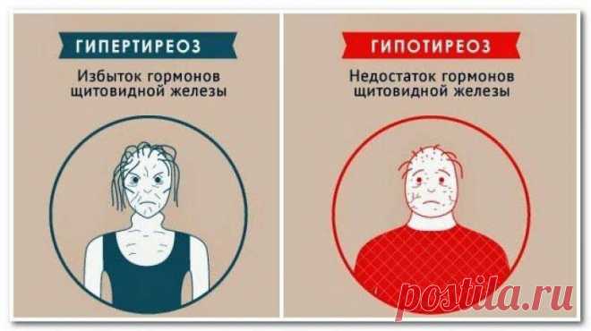 Норма ТТГ у женщин,и какой же результат правильный, а какой неверный?
ТТГ — это тест, обычно используемый для диагностики заболеваний щитовидной железы. Благодаря своей высокой чувствительности он позволяет обнаруживать проблемы на ранней стадии.   Исследование ТТГ также имеет некоторые ограничения, из-за довольно медленного наблюдения изменений, не рекомендуется проводить исследование в короткие...
Читай пост далее на сайте. Жми ⏫ссылку выше