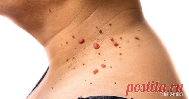 Как удалить раздражающие папилломы и бородавки раз и навсегда - Хитрости Жизни - медиаплатформа МирТесен