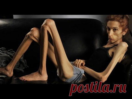 ИСТОРИЯ АНОРЕКСИИ Рэйчел Фаррух/Любопытные факты - YouTube