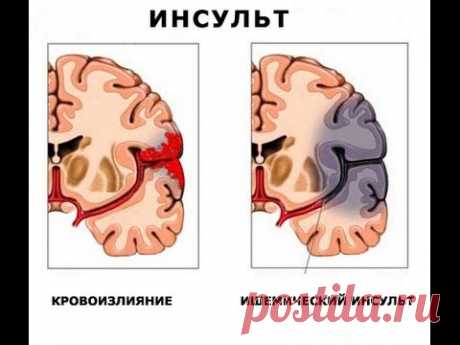 Что такое инсульт - конец или жизнь продолжается? Приглашение на встречу.