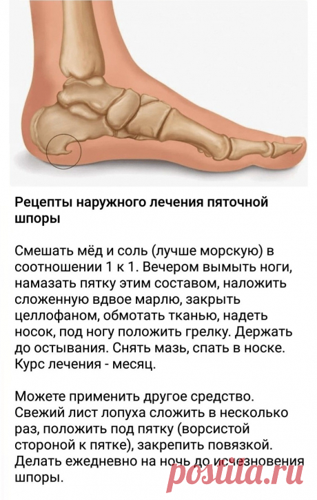Рецепты наружного лечения пяточной шпоры