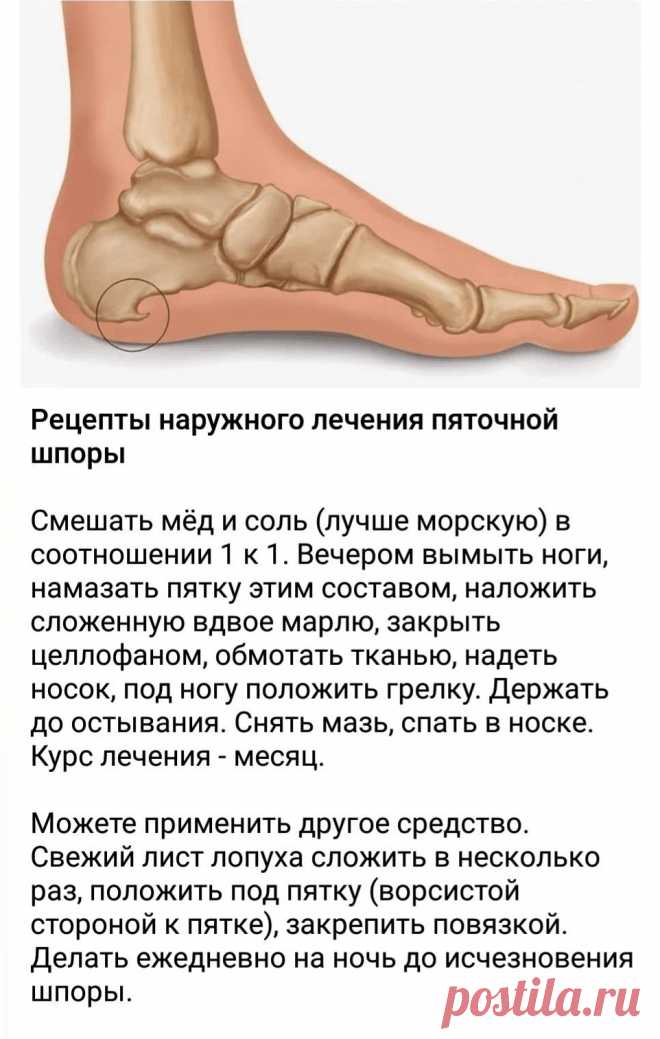 Рецепты наружного лечения пяточной шпоры