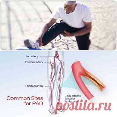 Атеросклероз сосудов ног - симптомы и диагностика