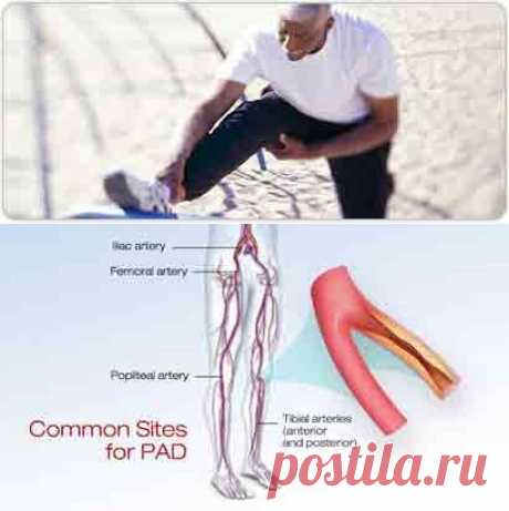 Атеросклероз сосудов ног - симптомы и диагностика