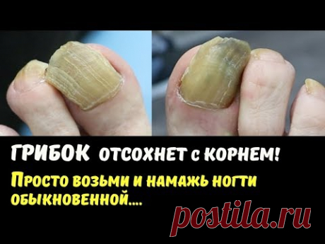 ГРИБОК Отсохнет с Корнем. Как быстро и эффективно вылечить грибок на ногах и руках.