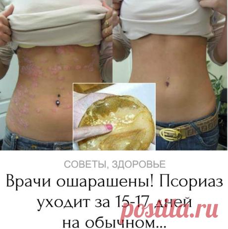 Невероятно! Вот чего действительно боится псориаз.
Нужно лишь... » vk.cc/5KP0Ot