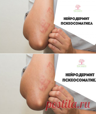 Нейродермит психосоматика