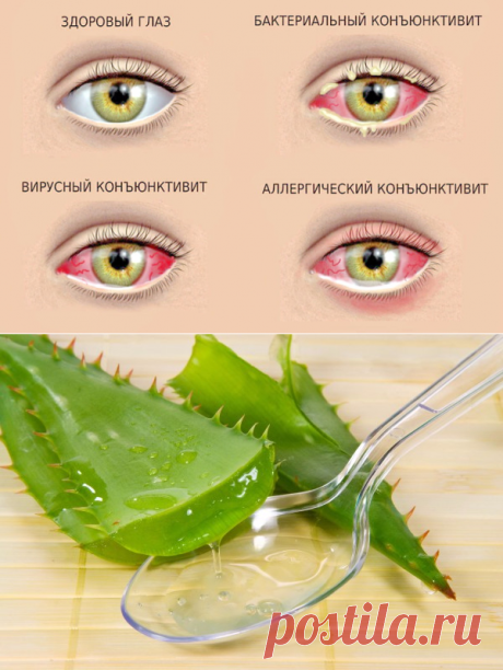 Коньюктивит: эффективное лечение натуральными средствами