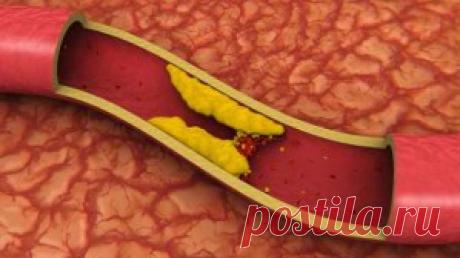 Холестерин. Норма в крови. Снижение. Лечение. - Болезни на KRASGMU.NET