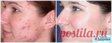 Чистая кожа за 2 месяца: Я расскажу вам как избавиться от угревой сыпи навсегда!