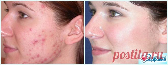 Чистая кожа за 2 месяца: Я расскажу вам как избавиться от угревой сыпи навсегда!