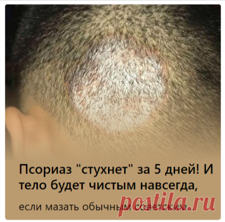 Псориаз "стухнет" за 5 дней! И тело будет чистым навсегда,
если мазать обычным советским...
тыквенные пироги